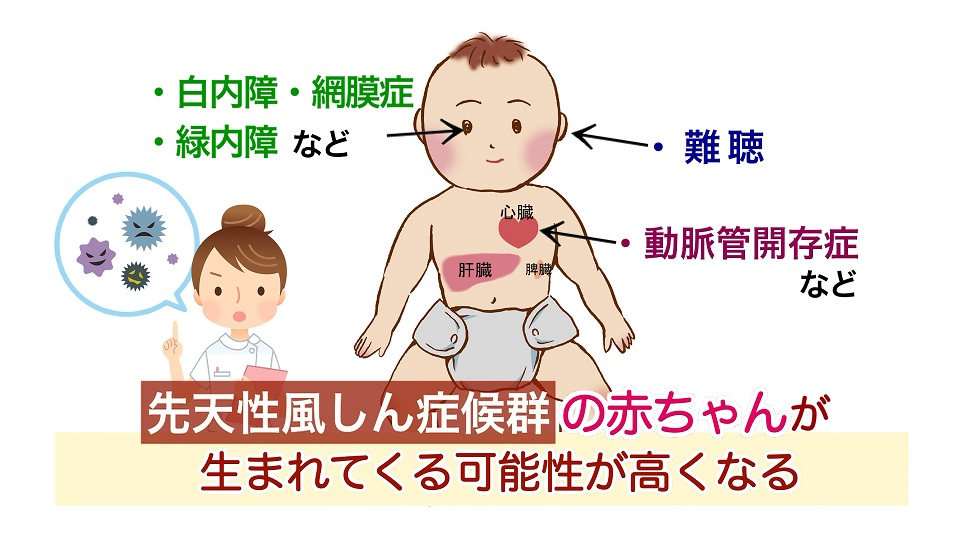先天性風しん症候群 (CRS)